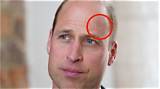 Prince William's Head Injury Raises Concerns About Royal Health and Public Safety