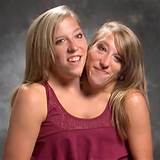Where Do Conjoined Twins Abby and Brittany Hensel Live Today?